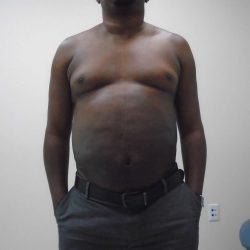 ULF Before & After Patient #583