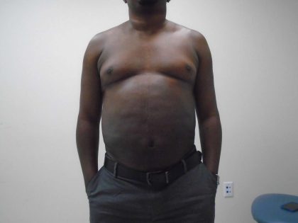 ULF Before & After Patient #583