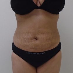 Lipo 360 Before & After Patient #511