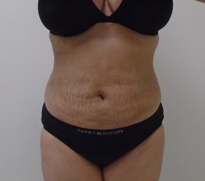 Lipo 360 Before & After Patient #511