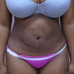 Lipo 360 Before & After Patient #502
