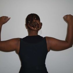 Arm Liposuction Before & After Patient #413