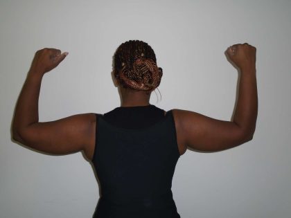 Arm Lift Before & After Patient #413