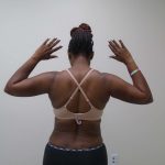 Arm Liposuction Before & After Patient #413