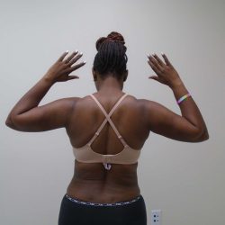 Arm Liposuction Before & After Patient #413