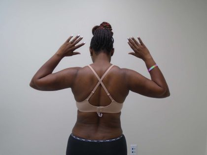 Arm Lift Before & After Patient #413