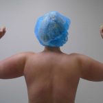 Arm Liposuction Before & After Patient #416