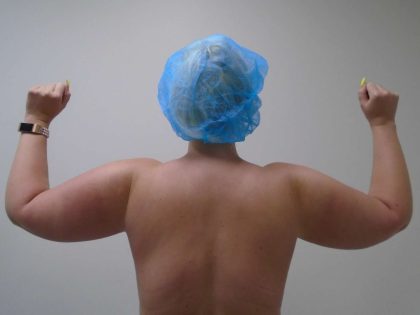 Arm Liposuction Before & After Patient #416
