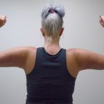 Arm Liposuction Before & After Patient #416