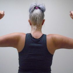 Arm Liposuction Before & After Patient #416