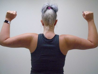 Arm Liposuction Before & After Patient #416