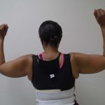 Arm Liposuction Before & After Patient #419
