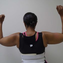Arm Liposuction Before & After Patient #419