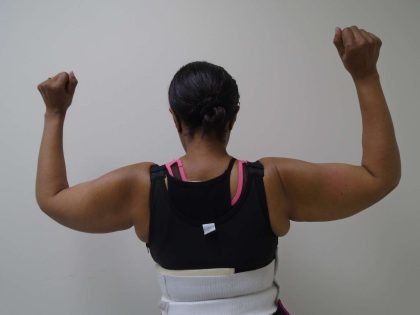 Arm Liposuction Before & After Patient #419