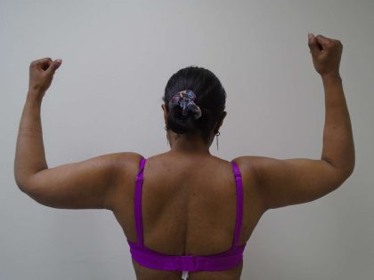 Arm Liposuction Before & After Patient #419