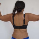 Arm Liposuction Before & After Patient #428
