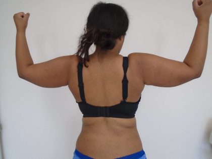 Arm Liposuction Before & After Patient #428