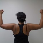 Arm Liposuction Before & After Patient #428