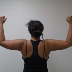 Arm Liposuction Before & After Patient #428