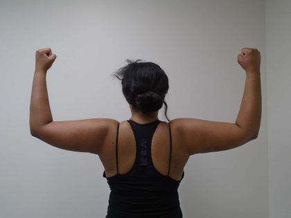 Arm Liposuction Before & After Patient #428