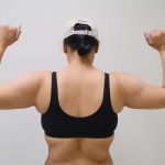 Arm Liposuction Before & After Patient #401