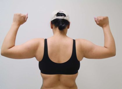 Arm Liposuction Before & After Patient #401