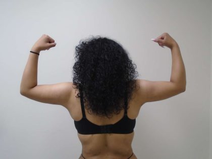 Arm Liposuction Before & After Patient #401
