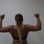 Arm Liposuction Before & After Patient #404