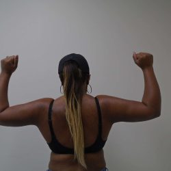 Arm Liposuction Before & After Patient #404
