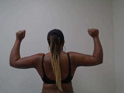Arm Liposuction Before & After Patient #404