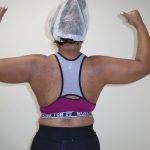 Arm Liposuction Before & After Patient #404