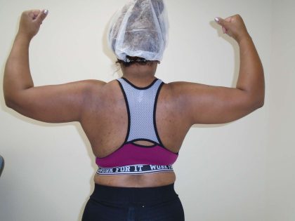 Arm Liposuction Before & After Patient #404