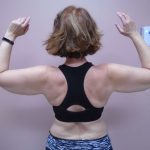 Arm Liposuction Before & After Patient #407