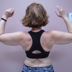 Arm Liposuction Before & After Patient #407