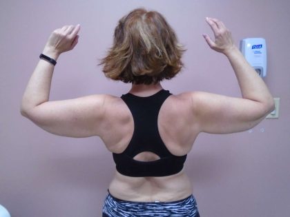 Arm Liposuction Before & After Patient #407