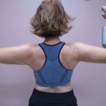 Arm Liposuction Before & After Patient #407