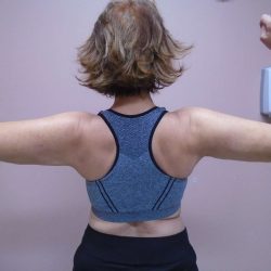 Arm Liposuction Before & After Patient #407