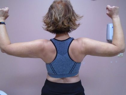 Arm Liposuction Before & After Patient #407