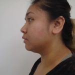 Chin Before & After Patient #464
