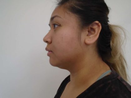 Chin Before & After Patient #464