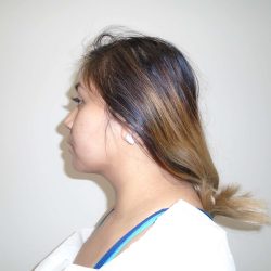 Chin Before & After Patient #464