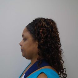 Chin Before & After Patient #467