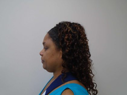 Chin Before & After Patient #467