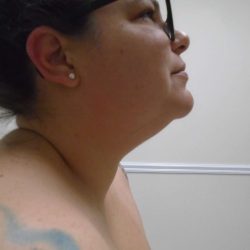 Chin Before & After Patient #470
