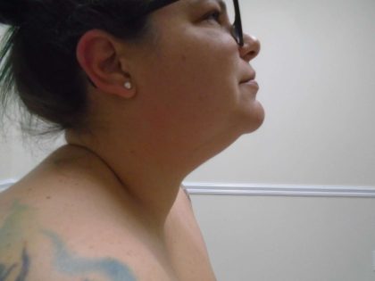 Chin Before & After Patient #470