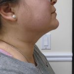 Chin Before & After Patient #470