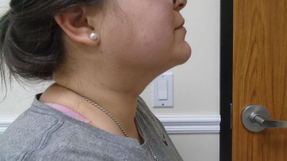 Chin Before & After Patient #470