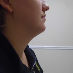 Chin Before & After Patient #473