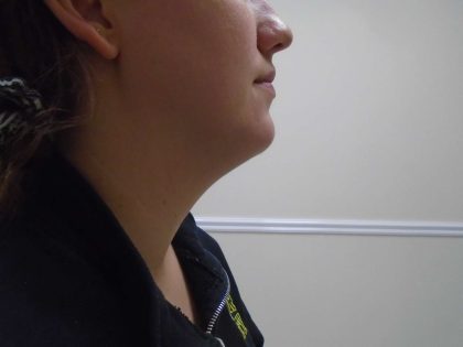 Chin Before & After Patient #473