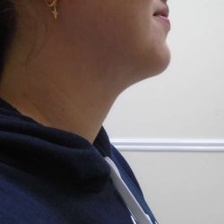 Chin Before & After Patient #473